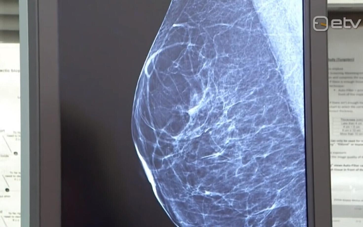 Скрининг рака груди.