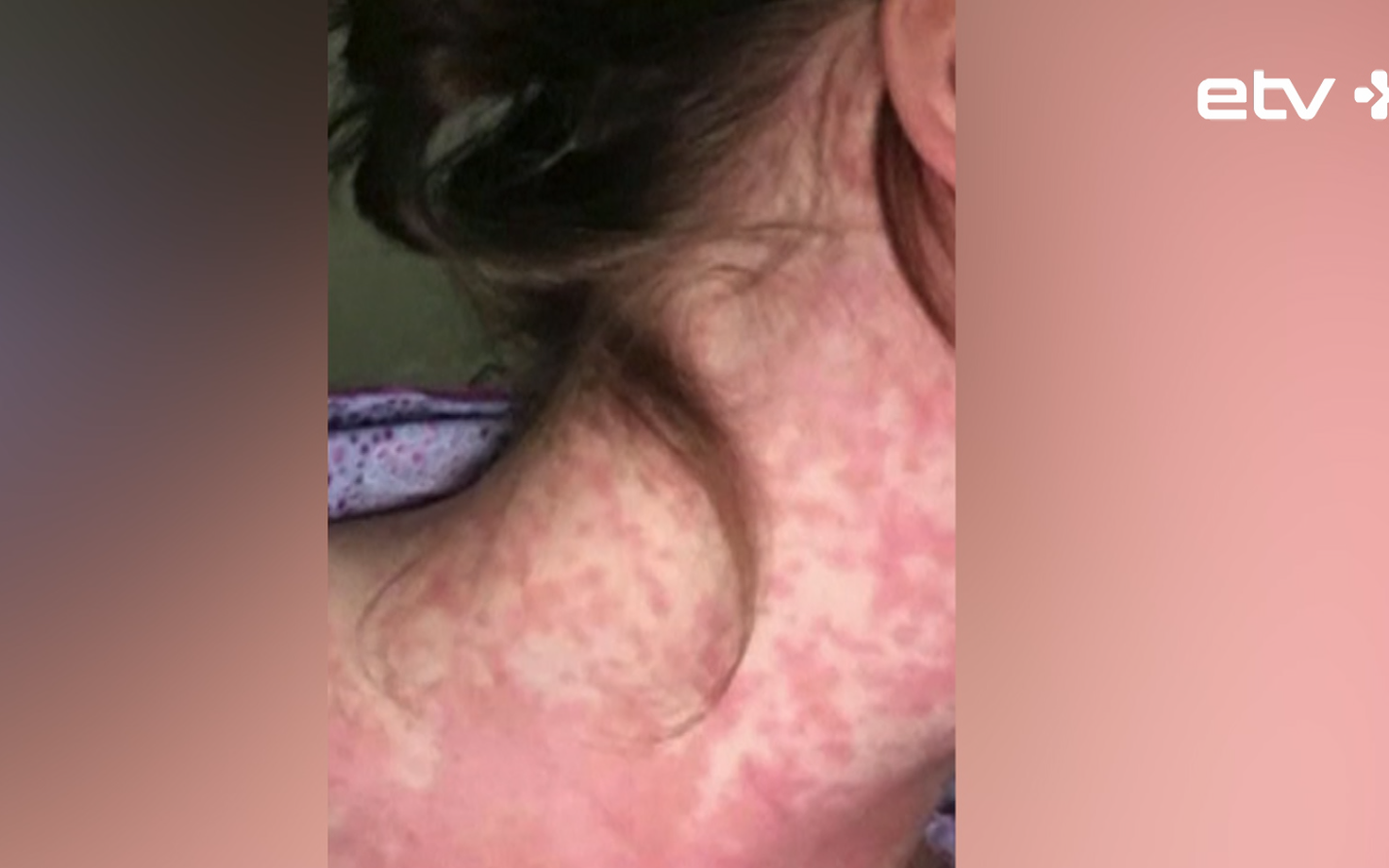 В Европе стремительно распространяется корь.