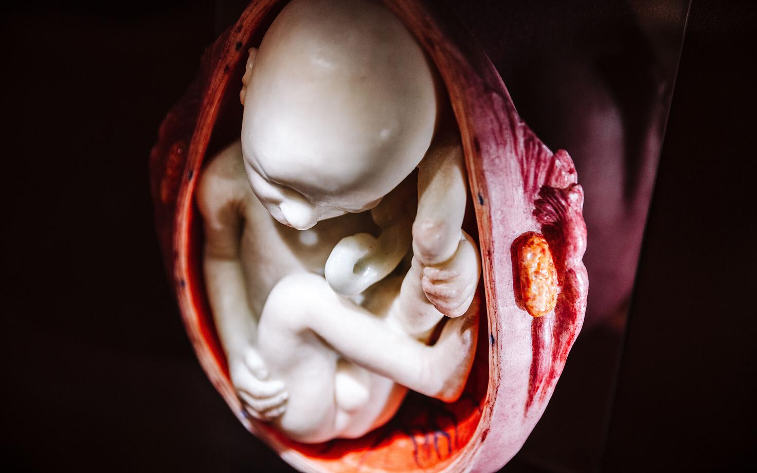According to Sildver, Estonia has managed to keep cesarean section rates more in line with Nordic trends.