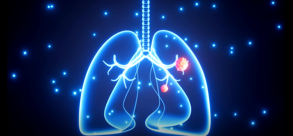 По распространенности среди злокачественных опухолей рак легких занимает четвертое место и крайне опасен.